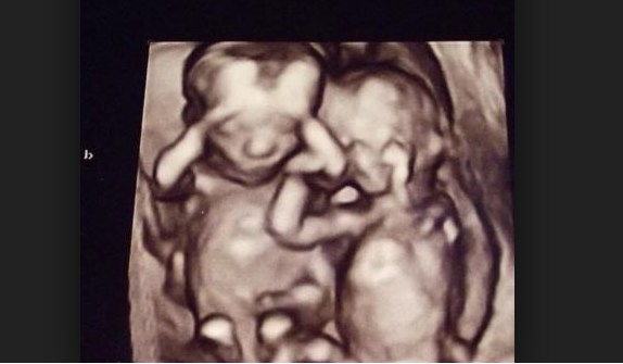 Video Of Twin Unborn Babies Provides Breathtaking Glimpse Inside The