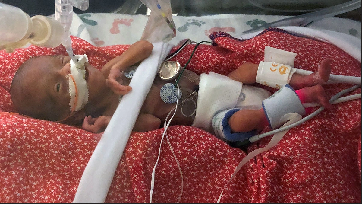 Premature Baby Born At Weeks Is One Of The Babeest Ever To Survive LifeNews Com