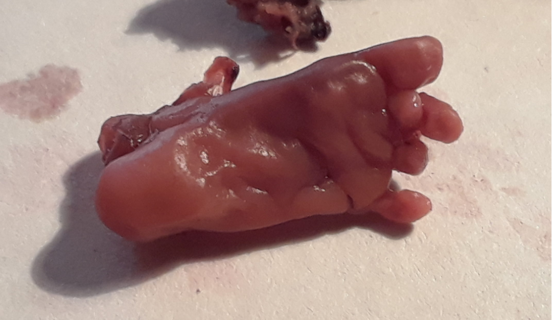 abortedbabysfoot.png