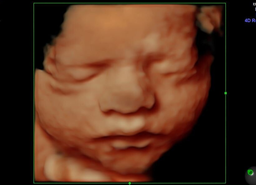 Killing Babies in Abortions is Wrong Medically, Ethically and Biblically